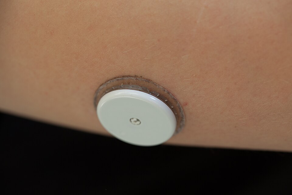 Close-up of a continuous glucose monitor sensor on a person's arm